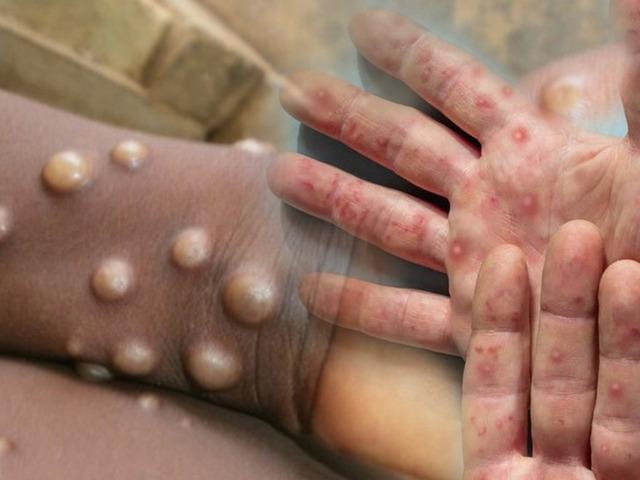 M çiçeği virüsü uyarısı: Salgın kıtayı aştı!