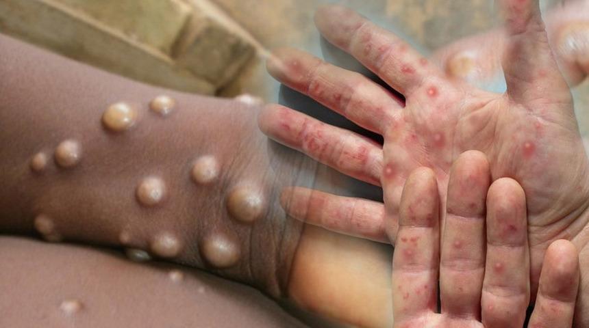 DSÖ'den M çiçeği virüsü uyarısı: Salgın kıtayı aştı! 'Kontrol altına alınmalı'