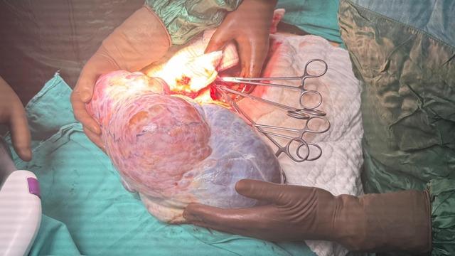 Ordu'da hastanın karnından 5 kiloluk kitle çıkarıldı