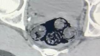 Vücudundaki 140 gram uyuşturucu radyolojik muayeneyle tespit edilen şüpheli tutuklandı