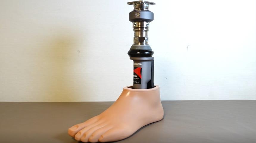 14 yıllık protez çilesi Türkiye’de son buldu... Rus hastanın hayata dönüş hikâyesi: Osseointegrasyonla kayıp bacağını geri kazandı