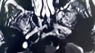 Beyninden 30 tenya yumurtası çıkardılar!