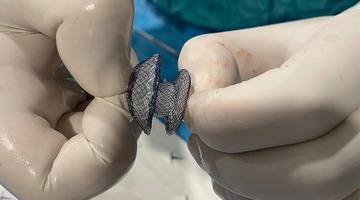 Çarpıntı, nefes darlığı ve yorgunluk varsa dikkat! Kalp deliği artık kapalı yöntemle tedavi edilebiliyor