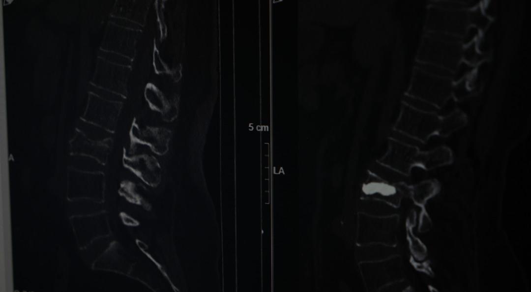 Düşme sonrası fıtık sandı: Omurgasında kırık çıktı! Uzmanlar kadınlarda yaşla gelen tehlikeye karşı uyardı! 3