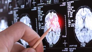 Çok nadir görülen yeni bir hastalık keşfedildi