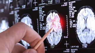 Çok nadir görülen yeni bir nörolojik hastalık keşfedildi: Sadece 13 kişide görüldü!