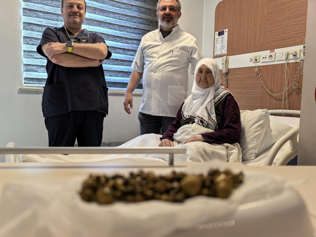 Karın ağrısıyla gitti: Safra kesesinden 213 tane taş &ccedil;ıktı!  4