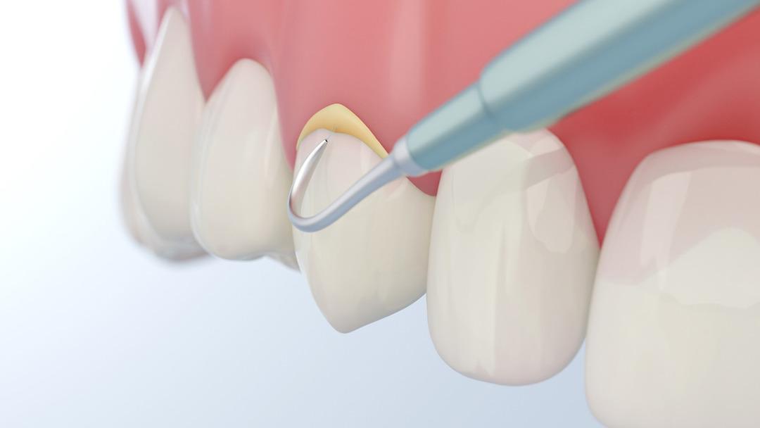 Ağız kokusu ve hatta diş kaybı... Diş tartarını görmezden gelmeyin 1