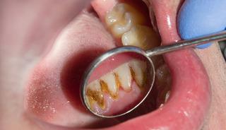 Ağız kokusu ve hatta diş kaybı... Diş tartarını görmezden gelmeyin