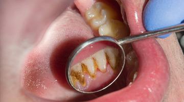 Ağız kokusu ve hatta diş kaybı... Diş tartarını görmezden gelmeyin