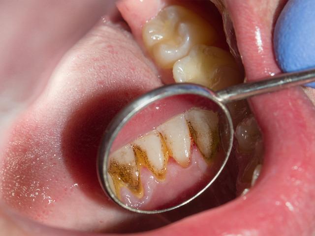 Ağız kokusu ve hatta diş kaybı... Diş tartarını görmezden gelmeyin