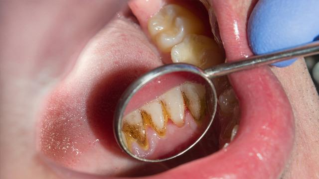 Ağız kokusu ve hatta diş kaybı... Diş tartarını görmezden gelmeyin