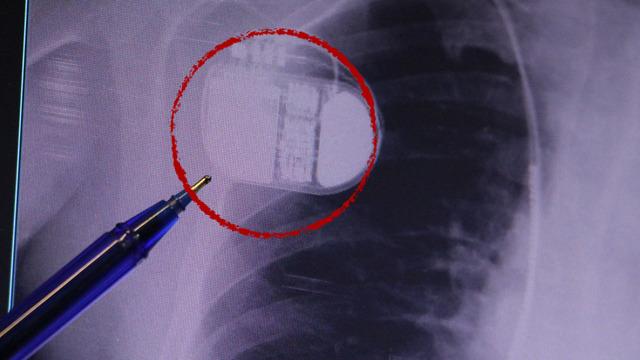 Kalp pili taşıyanlar dikkat! Soğuk hava uyarısı: Titreme cihazı yanıltabilir