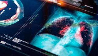 Türkiye'de her yıl 4 bin yeni vaka! Bu illere dikkat: Risk daha fazla!