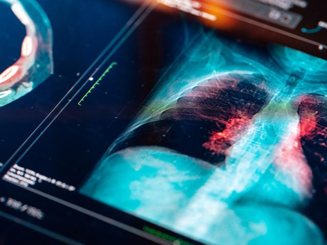 Türkiye'de her yıl 45 bin yeni vaka! Bu illere dikkat: Risk daha fazla!