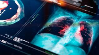 Türkiye'de her yıl 45 bin yeni vaka! Bu illere dikkat: Risk daha fazla!