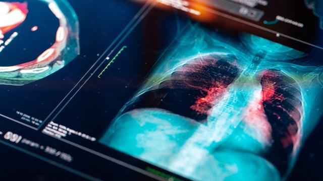 Türkiye'de her yıl 45 bin yeni vaka! Bu illere dikkat: Risk daha fazla!