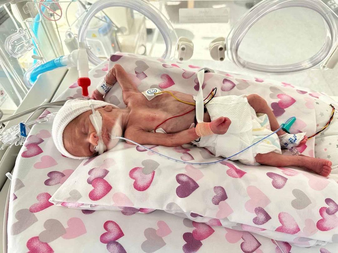 Mucize bebek... 600 gram doğdu: 98 g&uuml;n tedavi g&ouml;ren Asil bebek 2 yaşında 4