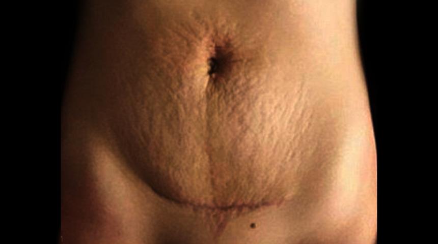 Herkesi bunu yapmaya davet ederek,  sezeryan izini gösterdi