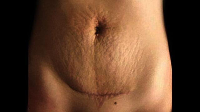 Herkesi bunu yapmaya davet ederek,  sezeryan izini gösterdi