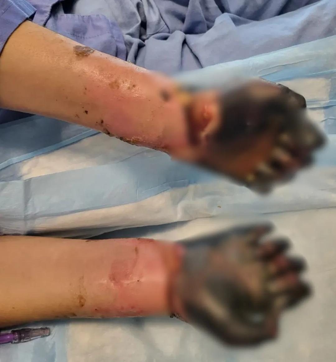 Çenesinde ağrı hissetti, tüm uzuvları ampute edildi!  2