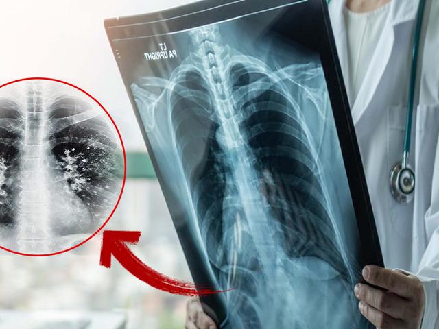 Gribi atlattınız mı? Asıl tehlike şimdi başlıyor: 'süperenfeksiyon' uyarısı