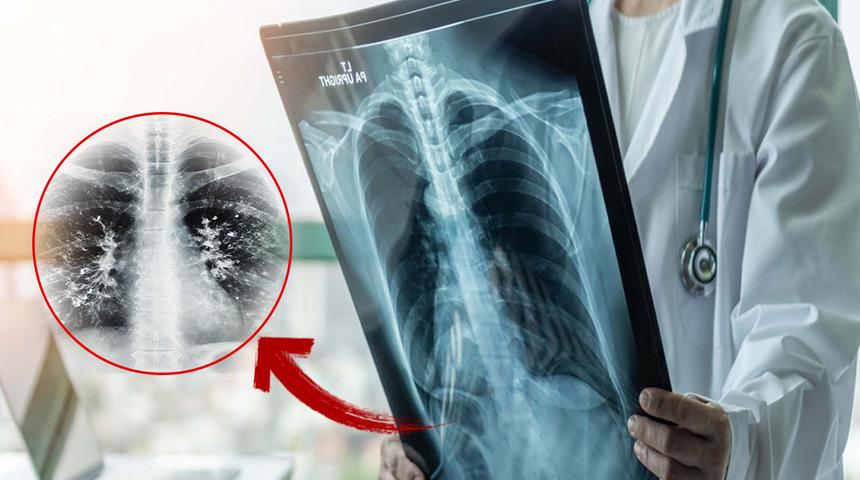 Gribi atlattınız mı? Asıl tehlike şimdi başlıyor: 'süperenfeksiyon' uyarısı