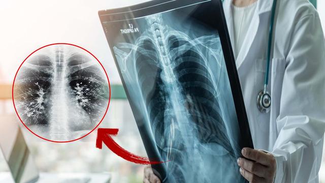 Gribi atlattınız mı? Asıl tehlike şimdi başlıyor: 'süperenfeksiyon' uyarısı