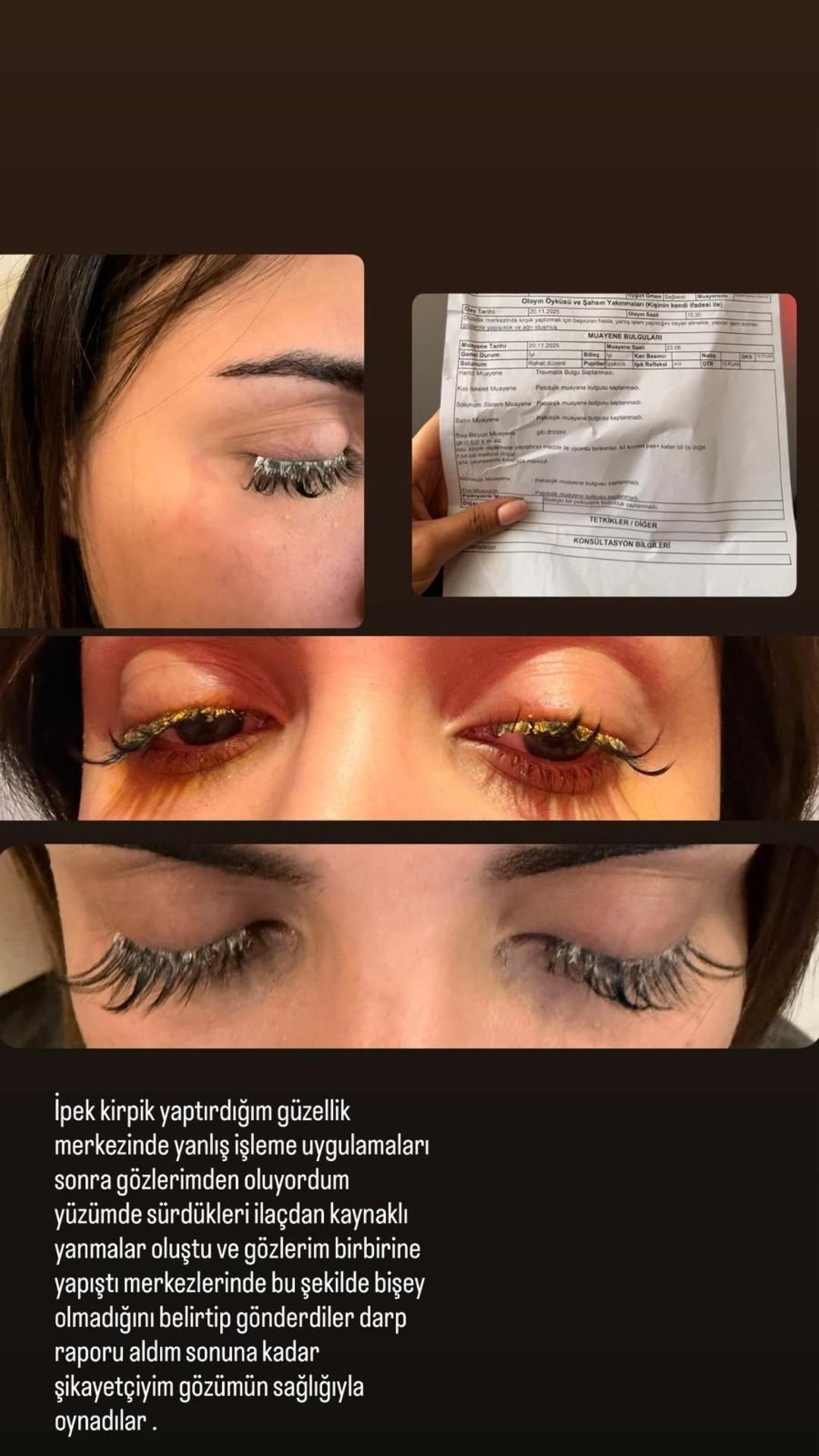 Kirpiklerini yaptırmaya gitti, g&ouml;z&uuml;ne yapıştırıcı ka&ccedil;tı! "K&ouml;r olabilirdim" 3