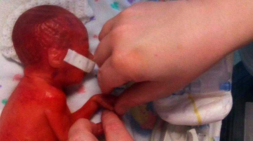 'Doğduğunda kırmızı bir uzaylıya benziyordu'