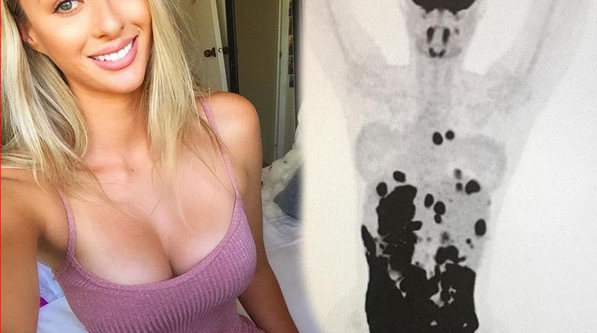 Kanser taramasını böyle paylaştı