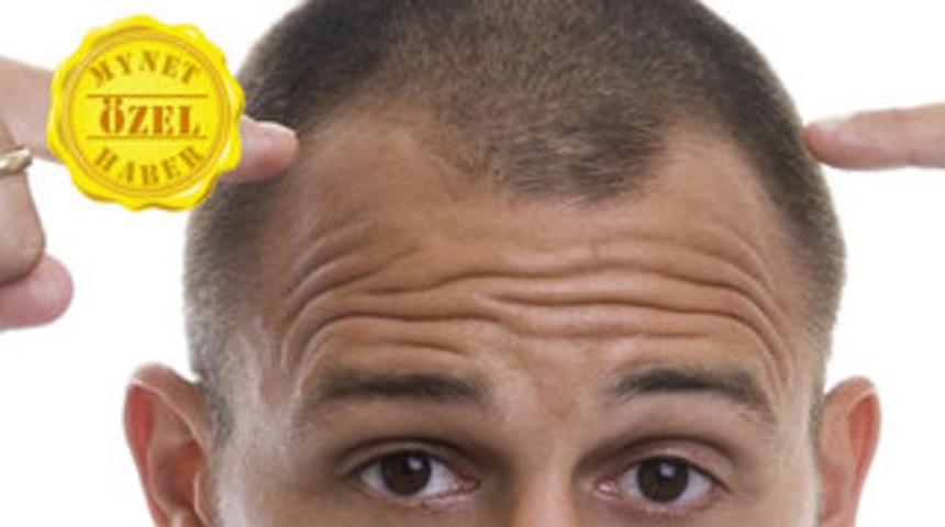 Saç ekiminden ne beklemelisiniz?