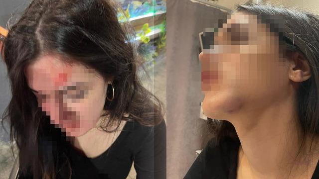 Eski sevgiliye 'tuzak'  iddiası! Genç kız darbedildiğini söyleyip fotoğrafları paylaştı