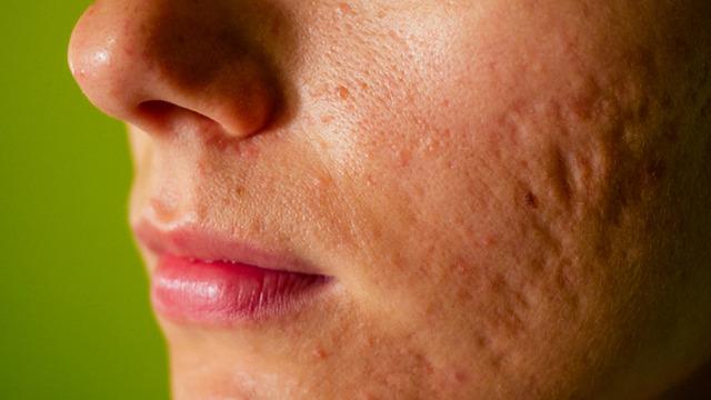 Binlerce liralık masraftan kurtulun: Yüzdeki sivilce çukurları nasıl geçer? 