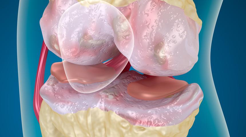 Eklem hastalıklarının tedavisinde robotik cerrahi devri