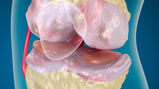 Bacak ağrısı deyip geçmeyin