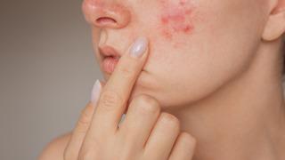 Sivilce tedavisinde kükürt içerikli ürünler kullanılır mı? Bu ürünler ne kadar etkili?