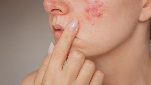 Sivilce tedavisinde kükürt içerikli ürünler kullanılır mı? Bu ürünler ne kadar etkili?