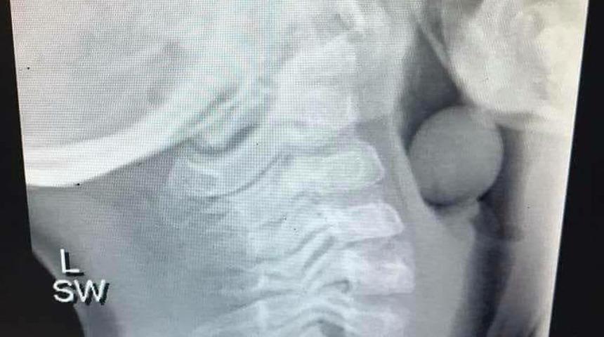 'Bu r&ouml;ntgen oğlumun boğazındaki...'