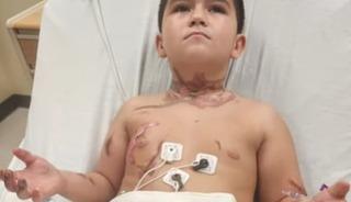 Kolyesi yüzünden az daha ölüyordu! Deri nakli yapılacak