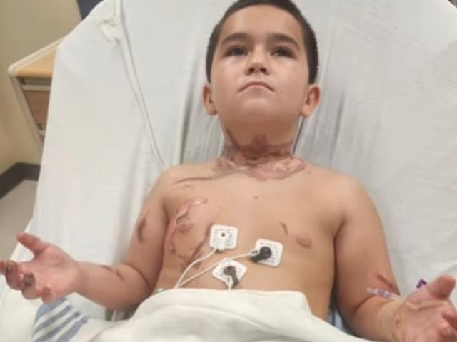 Kolyesi yüzünden az daha ölüyordu! Deri nakli yapılacak