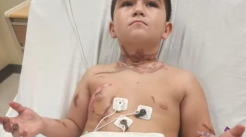 Kolyesi yüzünden az daha ölüyordu! Deri nakli yapılacak