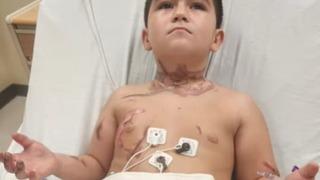 Kolyesi yüzünden az daha ölüyordu! Deri nakli yapılacak