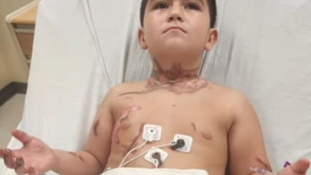 Kolyesi yüzünden az daha ölüyordu! Deri nakli yapılacak