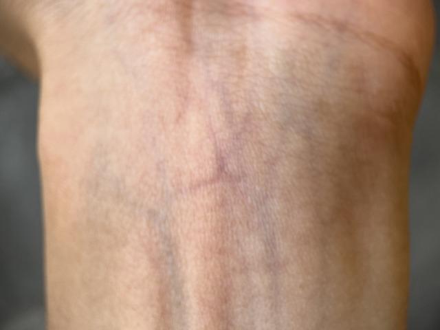 Kan damarları deride neden mavi görünür?