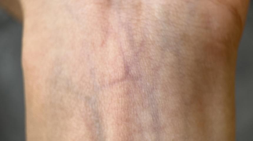 Kan damarları deride neden mavi görünür? Sebebi nedir?