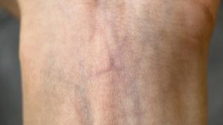 Kan damarları deride neden mavi görünür? Sebebi nedir?