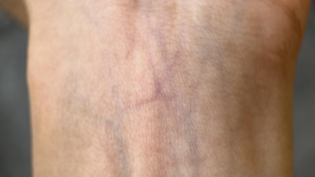 Kan damarları deride neden mavi görünür? Sebebi nedir?