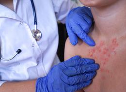 Vakalar dünyada artıyor: İngiltere MPOX virüsü alarmı verdi!