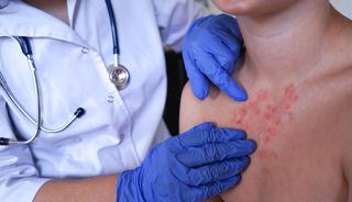 Vakalar dünyada artıyor: İngiltere MPOX virüsü alarmı verdi!